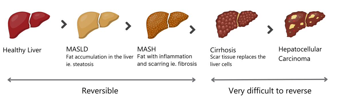 About Fatty Liver Disease